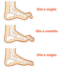 maglio-artiglio-martello-piede