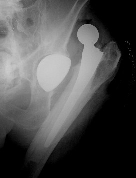 Rilievo radiografico di lussazione traumatica di artroprotesi d'anca