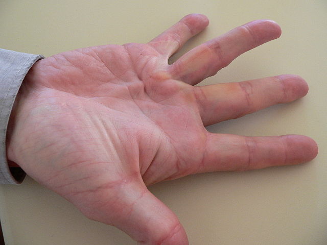 mano con morbo di dupuytren