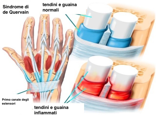 anatomia tenosinovite de Quervain