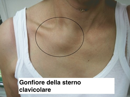 Gonfiore sterno clavicolare