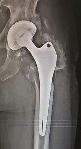 Quadro radiografico di osteolisi periprotesica massiva con scollamento del cotile