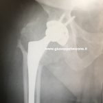 Analisi macroscopica dell'usura volumetrica di un inserto in polietilene