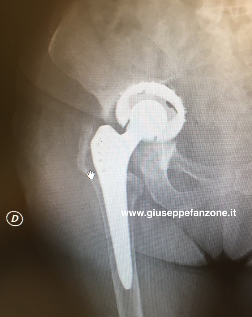 Quadro radiografico di mobilizzazione e migrazione intrapelvica del cotile d'anca