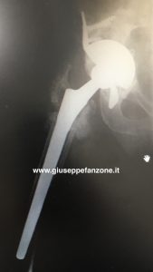 Controllo radiografico post-operatorio del sistema di revisione protesica d'anca TMARS Zimmer