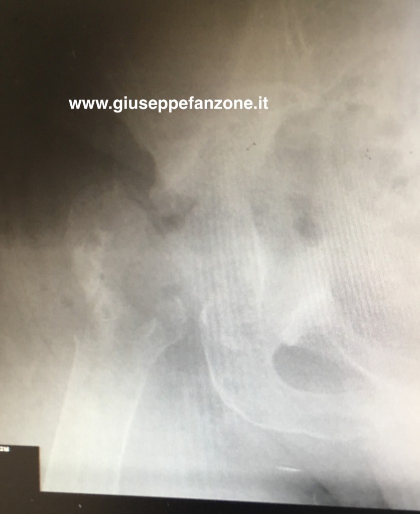 Rilievo radiografico post-espianto dei componenti protesici d'anca