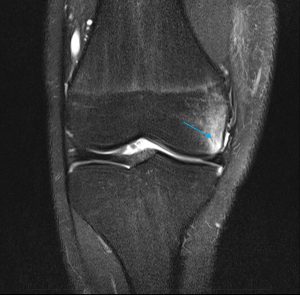 Imaging RM documentante iperintensità di segnale focale intraspongiosa