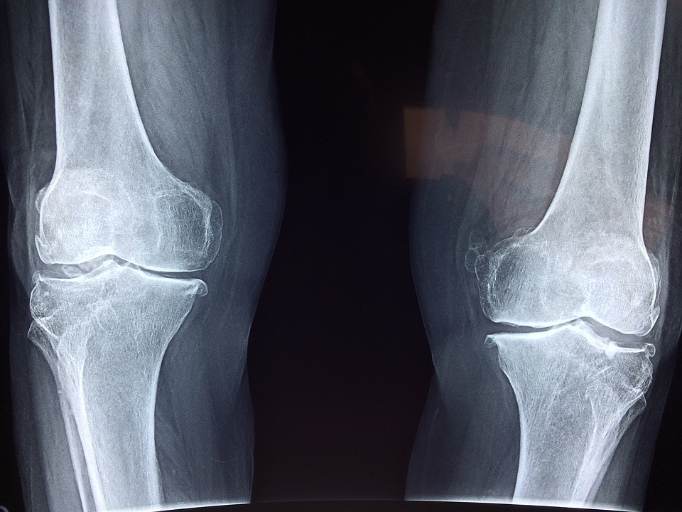 Radiografia convenzionale in carico del ginocchio affetto da gonartrosi mediale