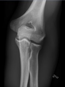 Radiografia antero-posteriore del gomito