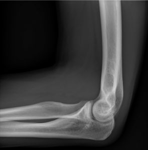 Radiografia laterale del gomito