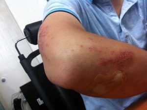 Esempio clinico di gonfiore da Morel-Lavallée al gomito