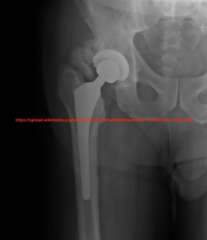 Radiografia ossificazione eterotopica anca