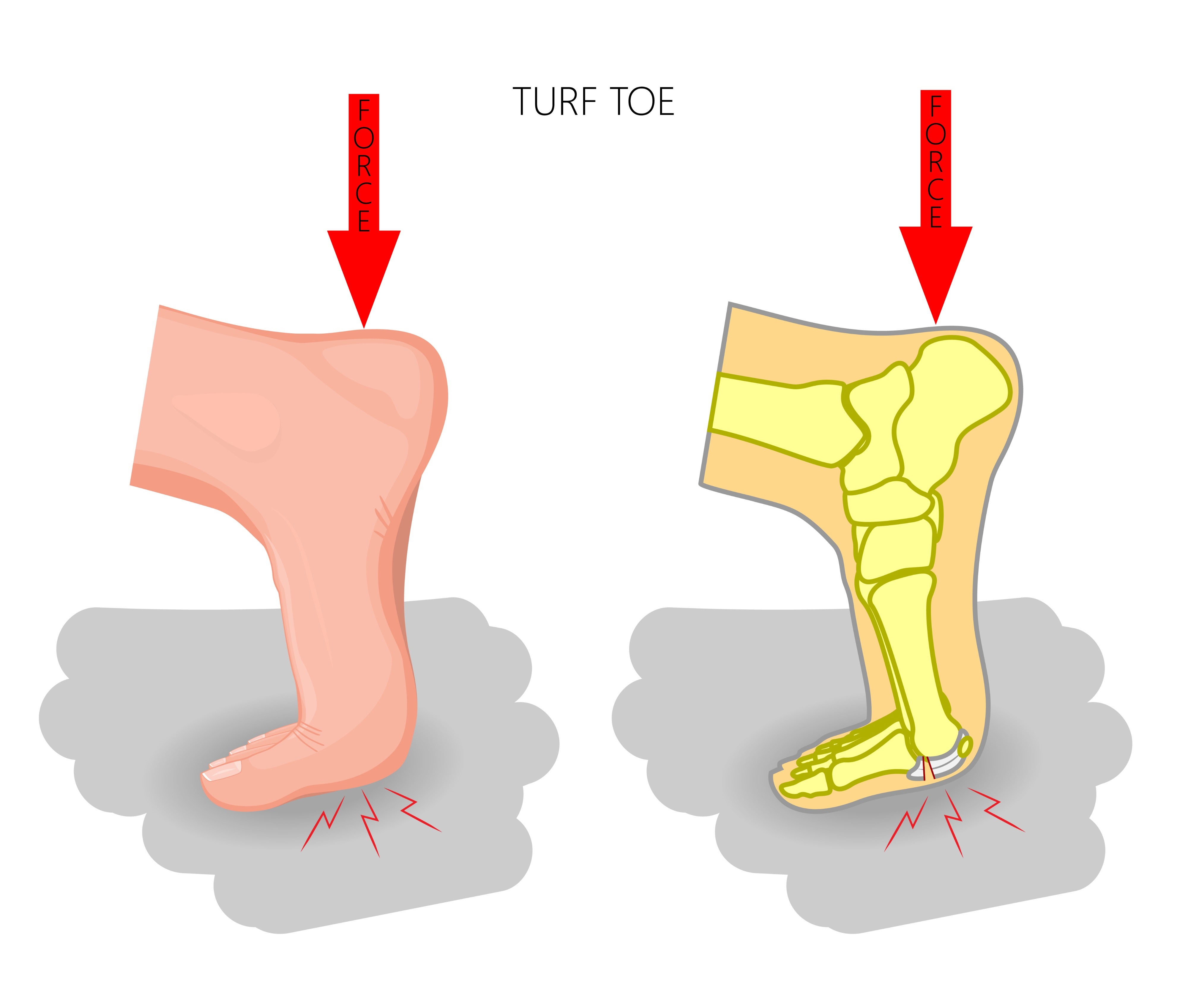 Diagramma lesione traumatica Turf Toe