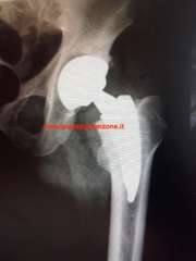 Rilievo radiografico post-operatorio di artroprotesi totale d'anca