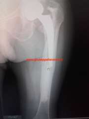 Radiografia di mobilizzazione asettica dello stelo femorale