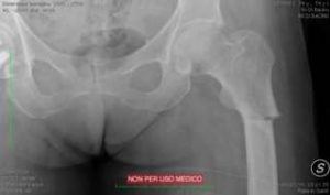Radiografia di frattura atipica del femore