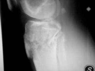 Radiografia frattura tibia epifisi
