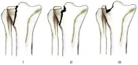 Classificazione Schatzker 1