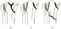 Classificazione Schatzker 2