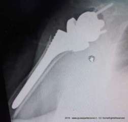 Radiografia pre-operatoria spalla