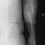 Sintesi con placca e viti Radiografia post-operatoria con placche e viti