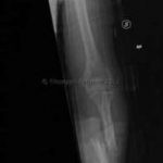 Frattura radio ed ulna Radiografia frattura scomposta radio e ulna
