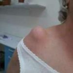 Esempio clinico segno del vulcano spalla