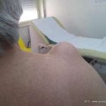 Tumefazione spalla rottura cuffia