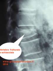 Radiografia frattura vertebra lombare
